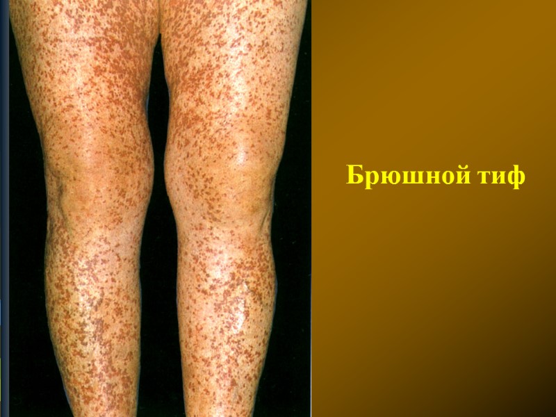 Брюшной тиф